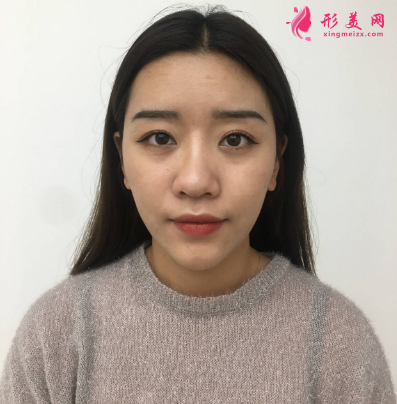 武漢德美余萌隆鼻術 武漢德美余萌隆鼻術