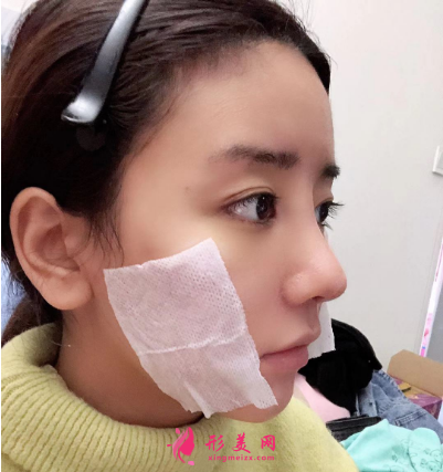 武漢德美余萌隆鼻術 武漢德美余萌隆鼻術