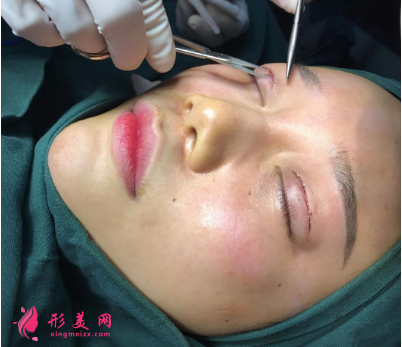 武漢德美劉小偉雙眼皮 武漢德美劉小偉雙眼皮