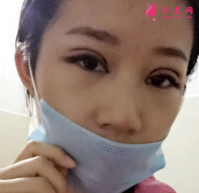 武漢德美劉小偉雙眼皮 武漢德美劉小偉雙眼皮