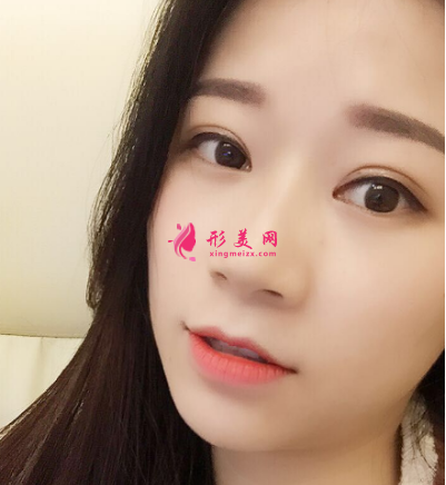 武漢德美劉小偉雙眼皮 武漢德美劉小偉雙眼皮