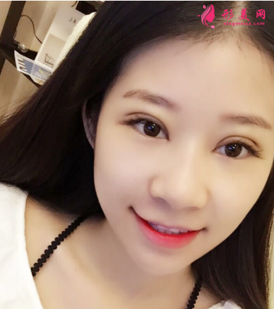 武漢德美劉小偉雙眼皮 武漢德美劉小偉雙眼皮