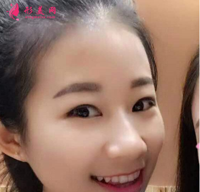 武漢德美劉小偉雙眼皮 武漢德美劉小偉雙眼皮