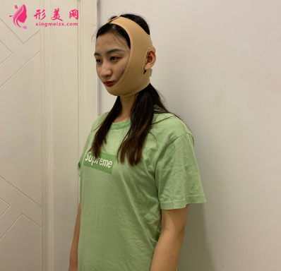 磨下頜角