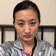 武漢五洲整形醫(yī)院做的磨下頜角，我也有瓜子臉了~