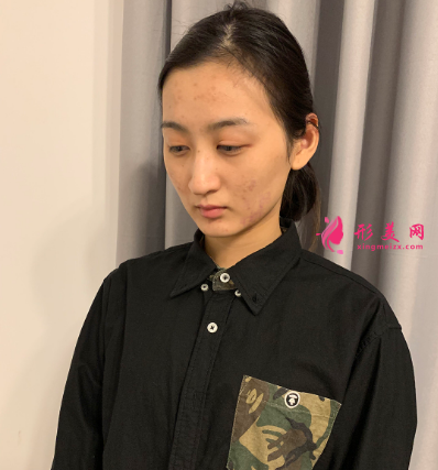 磨下頜角