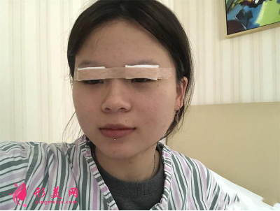 湖北省中醫(yī)院整形科胡霜紅雙眼皮 湖北省中醫(yī)院整形科胡霜紅雙眼皮