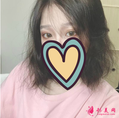 湖北省中醫(yī)院整形科胡霜紅雙眼皮 湖北省中醫(yī)院整形科胡霜紅雙眼皮