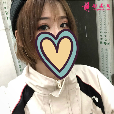 湖北省中醫(yī)院整形科胡霜紅雙眼皮 湖北省中醫(yī)院整形科胡霜紅雙眼皮