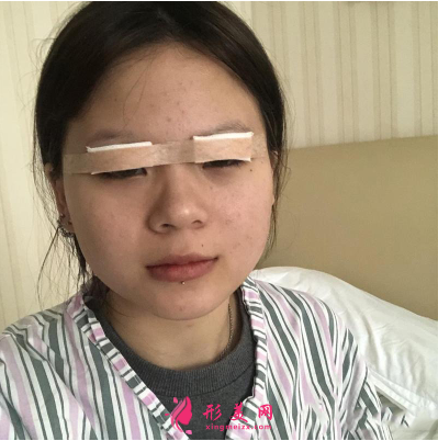 湖北省中醫(yī)院整形科胡霜紅雙眼皮 湖北省中醫(yī)院整形科胡霜紅雙眼皮