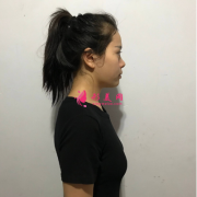 武漢一美整形醫(yī)院做假體隆胸，術(shù)后性感美胸上線了