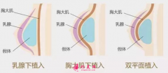 假體隆胸費用受什么因素影響？