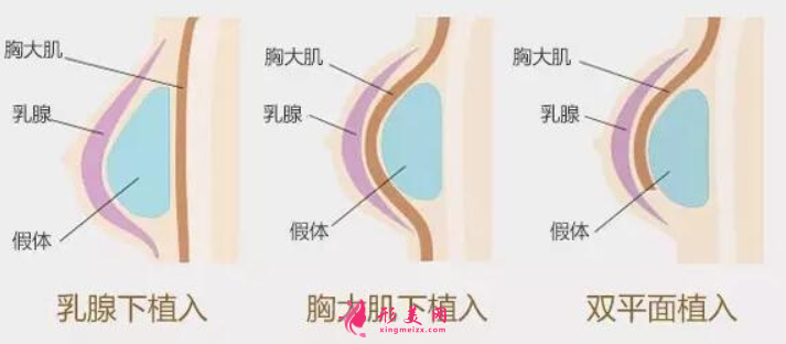 假體隆胸費用受什么因素影響