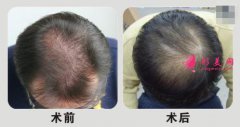 杭州植發(fā)醫(yī)院哪家好？如何挑選正規(guī)的醫(yī)院？植發(fā)前后對(duì)比圖