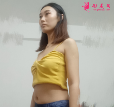 重慶美圣美邦整形醫(yī)院任志偉腰腹吸脂 重慶美圣美邦整形醫(yī)院任志偉腰腹吸脂