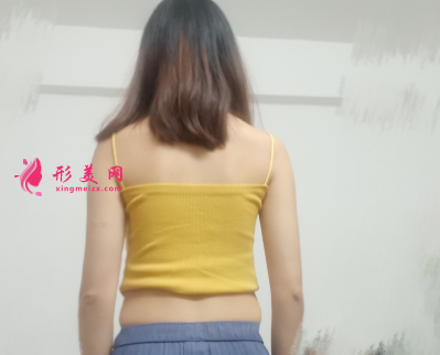 重慶美圣美邦整形醫(yī)院任志偉腰腹吸脂 重慶美圣美邦整形醫(yī)院任志偉腰腹吸脂