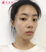 武漢藝星楊斐醫(yī)生給我做的鼻綜合，拯救了我的塌鼻子