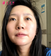 成都軍大整形醫(yī)院做隆鼻手術，經(jīng)驗豐富知名度很高