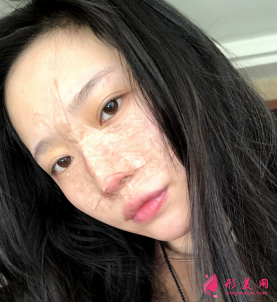 成都正好整形醫(yī)院劉志春做隆鼻手術(shù) 成都正好整形醫(yī)院劉志春做隆鼻手術(shù)