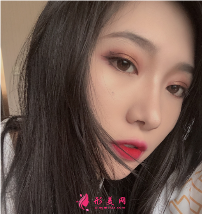 成都正好整形醫(yī)院劉志春做隆鼻手術(shù) 成都正好整形醫(yī)院劉志春做隆鼻手術(shù)
