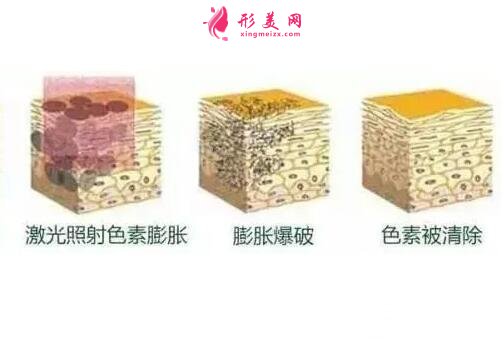 去除臉上黃褐斑