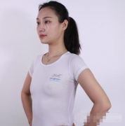 重慶西南醫(yī)院整形科隆胸效果實拍圖展示
