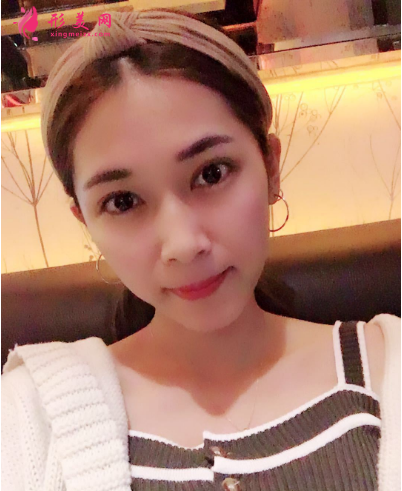 武漢韓辰整形醫(yī)院李相奇雙眼皮案例 武漢韓辰整形醫(yī)院李相奇雙眼皮案例