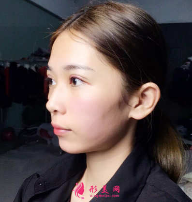 武漢韓辰整形醫(yī)院李相奇雙眼皮案例 武漢韓辰整形醫(yī)院李相奇雙眼皮案例