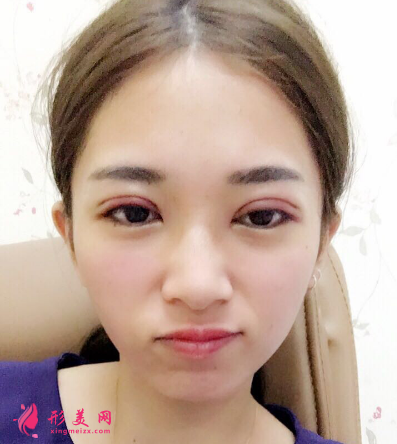 武漢韓辰整形醫(yī)院李相奇雙眼皮案例 武漢韓辰整形醫(yī)院李相奇雙眼皮案例