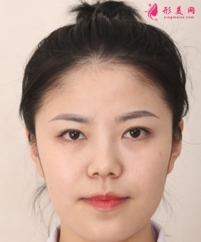 武漢韓辰整形醫(yī)院樊輝華面部吸脂 武漢韓辰整形醫(yī)院樊輝華面部吸脂