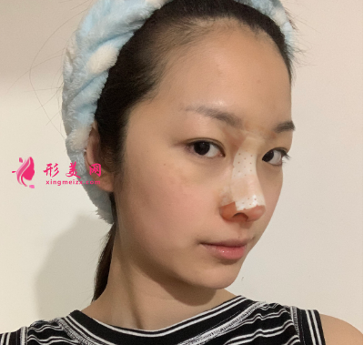 武漢韓辰整形醫(yī)院牛永敢隆鼻技術(shù) 武漢韓辰整形醫(yī)院牛永敢隆鼻技術(shù)