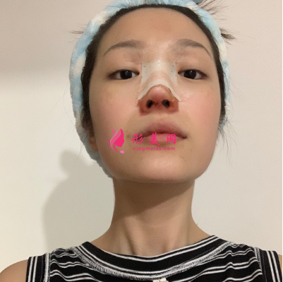 武漢韓辰整形醫(yī)院牛永敢隆鼻技術(shù) 武漢韓辰整形醫(yī)院牛永敢隆鼻技術(shù)