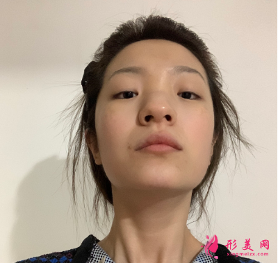 武漢韓辰整形醫(yī)院牛永敢隆鼻技術(shù) 武漢韓辰整形醫(yī)院牛永敢隆鼻技術(shù)