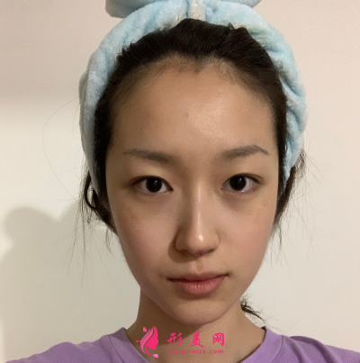 武漢韓辰整形醫(yī)院牛永敢隆鼻技術(shù) 武漢韓辰整形醫(yī)院牛永敢隆鼻技術(shù)