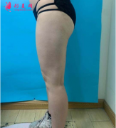 成都怡脂整形醫(yī)院大腿吸脂案例，看大腿變細(xì)了是不是穿啥都好看