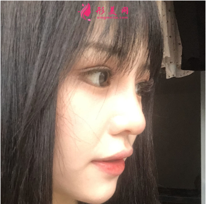 成都美雅娜整形醫(yī)院廖連平假體隆鼻