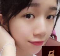 上海鉑曼醫(yī)療美容醫(yī)院隆鼻案例效果分享~