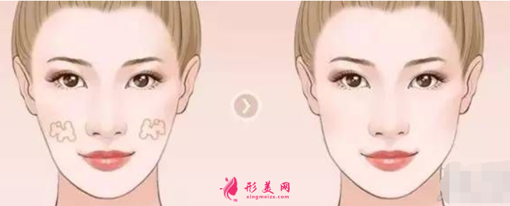 自體脂肪填充臉部要做幾次