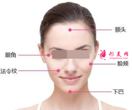 面部埋線提升腫脹期多久