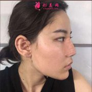從小塌鼻子，找成都菲兒瑞楊樹楷做隆鼻，鼻子不要太好看