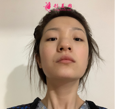 武漢韓辰整形醫(yī)院牛永敢隆鼻技術(shù) 武漢韓辰整形醫(yī)院牛永敢隆鼻技術(shù)