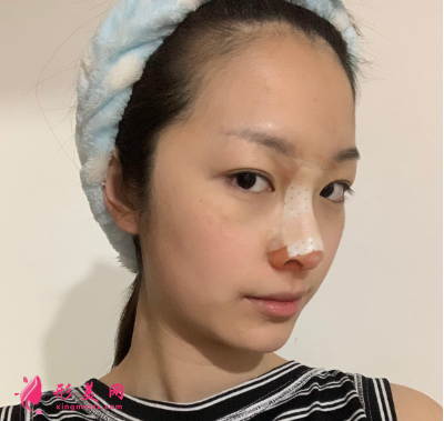 武漢韓辰整形醫(yī)院牛永敢隆鼻技術(shù) 武漢韓辰整形醫(yī)院牛永敢隆鼻技術(shù)