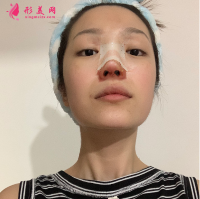 武漢韓辰整形醫(yī)院牛永敢隆鼻技術(shù) 武漢韓辰整形醫(yī)院牛永敢隆鼻技術(shù)