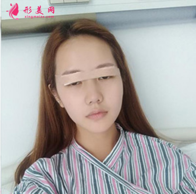 上海東方麗人整形醫(yī)院吳建明雙眼皮案例 上海東方麗人整形醫(yī)院吳建明雙眼皮案例