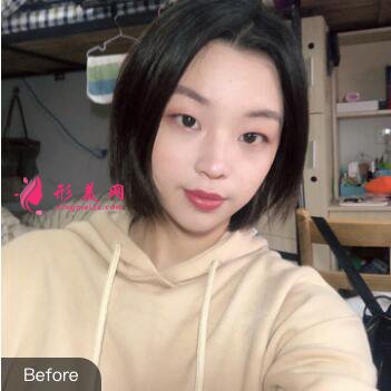 雙眼皮整形前
