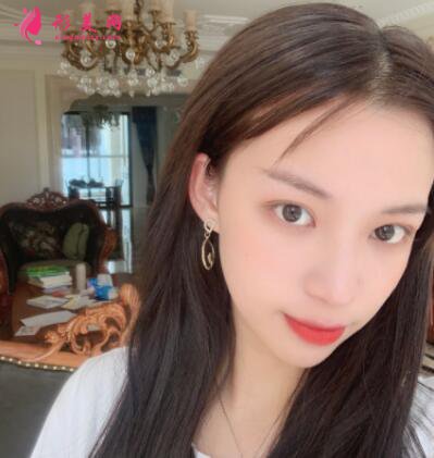 雙眼皮整形
