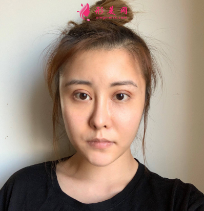武漢米蘭整形醫(yī)院王楷雙眼皮 武漢米蘭整形醫(yī)院王楷雙眼皮