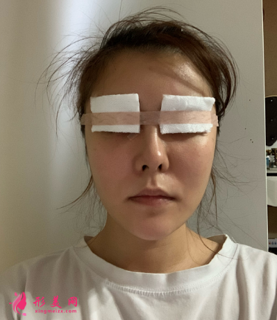 武漢米蘭整形醫(yī)院王楷雙眼皮 武漢米蘭整形醫(yī)院王楷雙眼皮