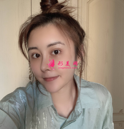 武漢米蘭整形醫(yī)院王楷雙眼皮 武漢米蘭整形醫(yī)院王楷雙眼皮