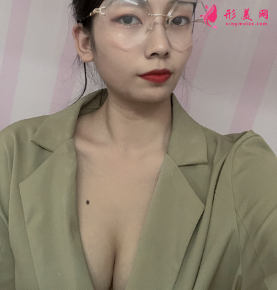 上海港華整形醫(yī)院呂金陵豐胸案例 上海港華整形醫(yī)院呂金陵豐胸案例